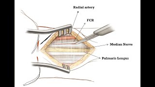 Volar Henry Approach to the Wrist [upl. by Roldan]