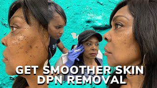 DPN removal for smoother skin [upl. by Clare876]