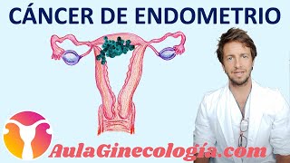 CÁNCER DE ENDOMETRIO I Causas síntomas tipos grados diagnóstico  Ginecología y Obstetricia [upl. by Routh]