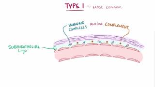 Membranous Nephropathy vs Membranoproliferative Glomerulonephritis [upl. by Segalman]