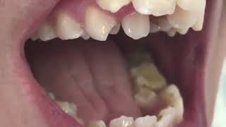 Severe Teeth Crowding [upl. by Siradal]