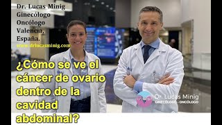 👍 ¿Cómo se ve el cáncer de ovario dentro de la cavidad abdominal Dr Lucas Minig Valencia España [upl. by Tammy]