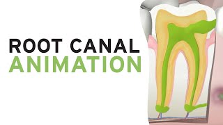 Root Canal Treatment RCT Step by Step Animation [upl. by Avlis935]