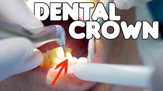 Dental Crown Procedure EXPLAINED [upl. by Latsirhc]