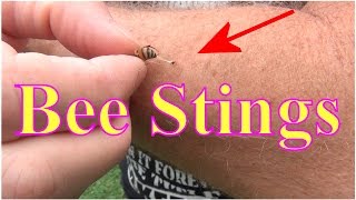 Beekeeping Bee Stings Ouch Stung By A Honey Bee Now What [upl. by Arrais]