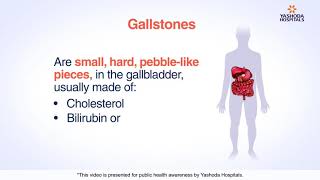 Gallstones  Cholelithiasis Symptoms Causes Diagnosis and Treatment [upl. by Theta]