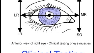 DEYE with a dilated pupil [upl. by Prem775]