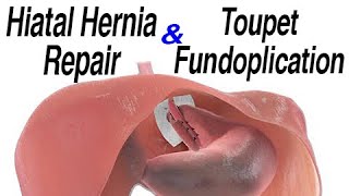 Hiatal Hernia Repair with Toupet Fundoplication to Treat Reflux Animation [upl. by Mcclelland516]