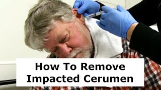 Removing Impacted Cerumen from a Patients Ear [upl. by Eduardo]