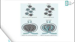 Glomerulonephritis [upl. by Iccir]