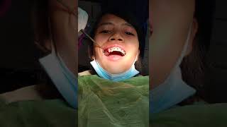 4 Premolar extraction for braces [upl. by Emmeram]