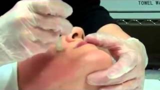 Dermapen Micro Needling Treatment [upl. by Joyce]