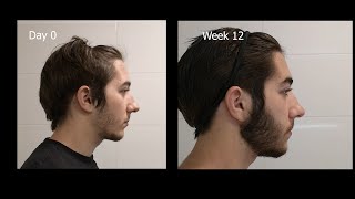 Minoxidil Beard Growth  3 Month Transformation  Timelapse BEFORE and AFTER [upl. by Schargel]