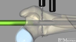 ILoc® IM Fixator Interlocking Nail  BioMedtrix [upl. by Leviram]