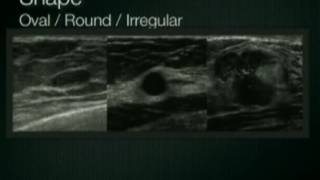 Breast Ultrasound Lesion Assessment BIRADS Ultrasound [upl. by Niko]