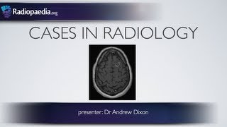 How To Read A Brain MRI  Neuroradiology Made Easy Maybe [upl. by Abrahams]