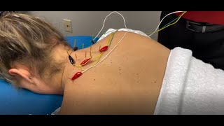 Dry Needling Demonstration and Explanation [upl. by Zigmund201]