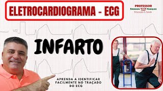 COMO IDENTIFICAR UM INFARTO NO ECG [upl. by Intisar]