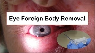 Eye Foreign Body Removal [upl. by Annauqahs979]