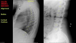 Introduction to Spine Radiographs [upl. by Osmo]