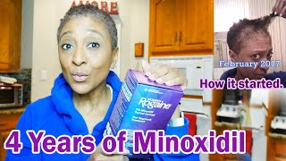 UPDATE  Minoxidil  4 YEARS LATER  TV Blake Review [upl. by Giulio396]