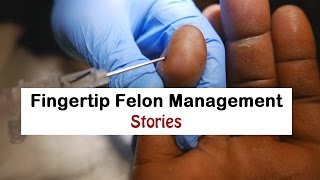 Fingertip Felon Management Stories [upl. by Leruj]