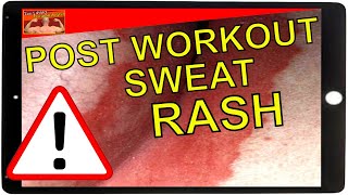 How To Treat Sweat Rash [upl. by Birecree496]