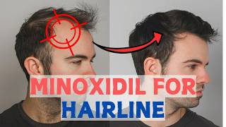 Minoxidil for Frontal Baldness  Restore Your Hairline [upl. by Benton]