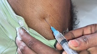 Ketorolac Arm Intramuscular injection Video 25 Ep57 [upl. by Nilac30]