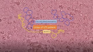 Urine of UTI patient under the Microscope [upl. by Jump158]