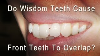 Do Wisdom Teeth Cause Front Teeth To Overlap and Get Crowded [upl. by Swiercz]