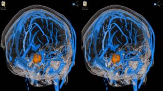 Acoustic Neuroma  3D Virtual Tour  UCLA Neurosurgery [upl. by Alena]