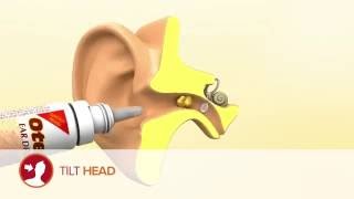 How to use Otex Ear Drops [upl. by Robison]