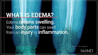 What is Edema  WebMD [upl. by Hanae]