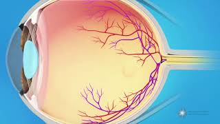 What causes a macular pucker [upl. by Auburn954]