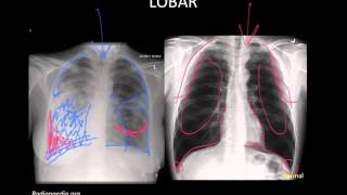 Pneumonia Imaging [upl. by Ahsyat]