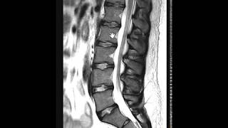 Importance of STIR images in lumbar spine [upl. by Ciapas]