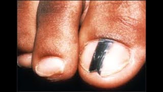 Are Black Toenail Lines amp Streaks Safe Doctor Treatment [upl. by Vito]