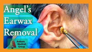 Angels Earwax Removal  Auburn Medical Group [upl. by Enicnarf641]