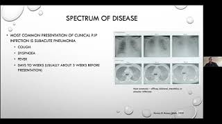 Pneumocystis jirovecii pneumonia  Current Issues in its Management [upl. by Shaver]