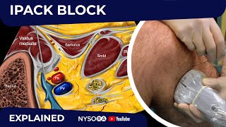 IPACK Block  Regional anesthesia Crash course with Dr Hadzic [upl. by Mauri225]