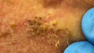 Extremely Clogged Pores Extracted  Contour Dermatology [upl. by Kcam641]