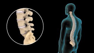 Lesiones de disco lumbar y tratamiento [upl. by Tyra]