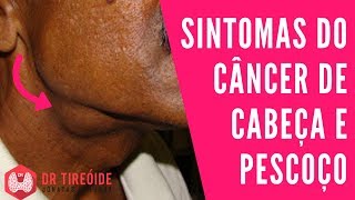 Sintomas do Câncer de Cabeça e Pescoço  Dr Jônatas Catunda [upl. by Uaerraj206]