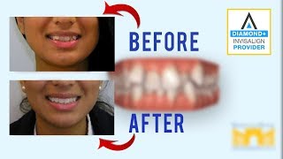 Invisalign Before and After Crowded Teeth [upl. by Ecissej]