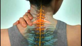 Cervical Radiculopathy  DePuy Videos [upl. by Derej666]