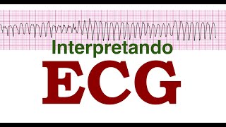 Interpretando ECG [upl. by Leitnahs766]