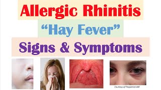 Allergic Rhinitis Hay Fever amp Seasonal Allergies Signs amp Symptoms amp Why They Occur [upl. by Aiseneg]