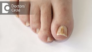 What are causes of vertical dark line on big toe  Dr Rajdeep Mysore [upl. by Mattheus]