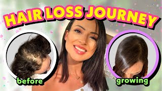 HAIR LOSS TREATMENT FOR WOMEN MY FEMALE HAIR LOSS JOURNEY  TIPS ON HAIR LOSS [upl. by Eden598]